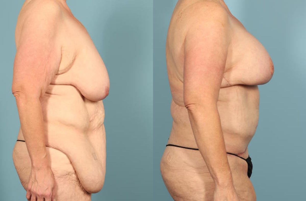 Weight Loss Body Contouring Before & After Gallery - Patient 203186 - Image 5