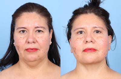 Facelift Before & After Gallery - Patient 396972 - Image 1