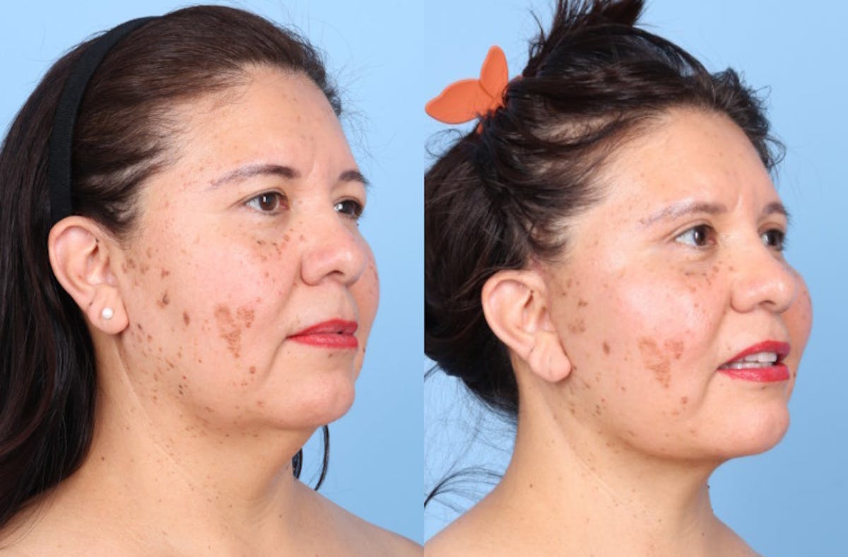 Facelift Before & After Gallery - Patient 396972 - Image 2