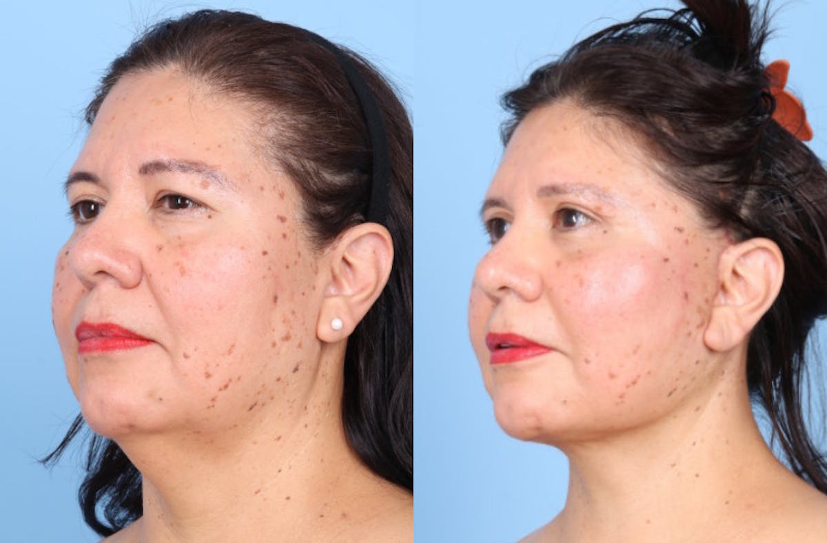 Facelift Before & After Gallery - Patient 396972 - Image 3
