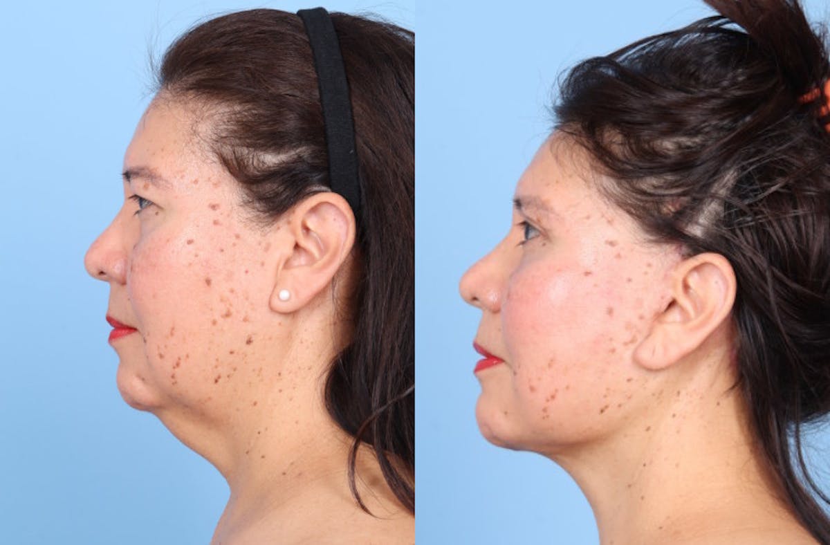 Facelift Before & After Gallery - Patient 396972 - Image 4