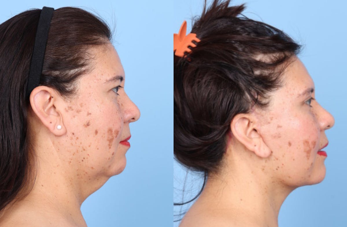 Facelift Before & After Gallery - Patient 396972 - Image 5