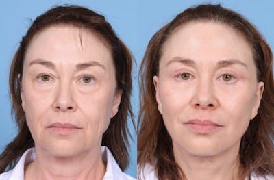 Facelift Before & After Gallery - Patient 369997 - Image 1
