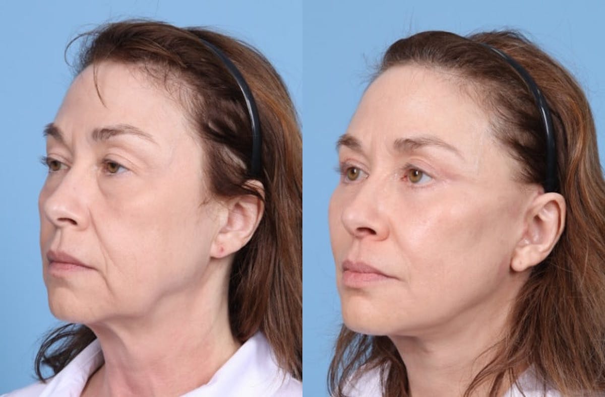 Facelift Before & After Gallery - Patient 369997 - Image 2