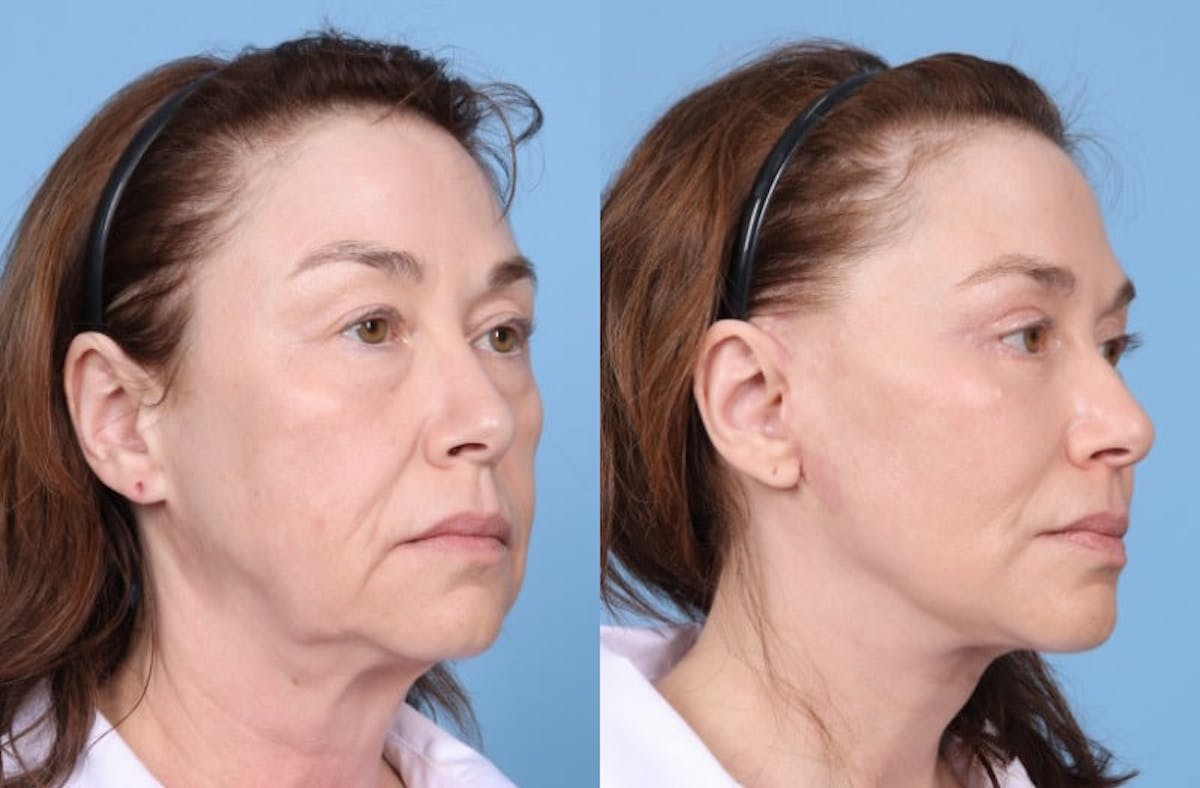 Facelift Before & After Gallery - Patient 369997 - Image 3
