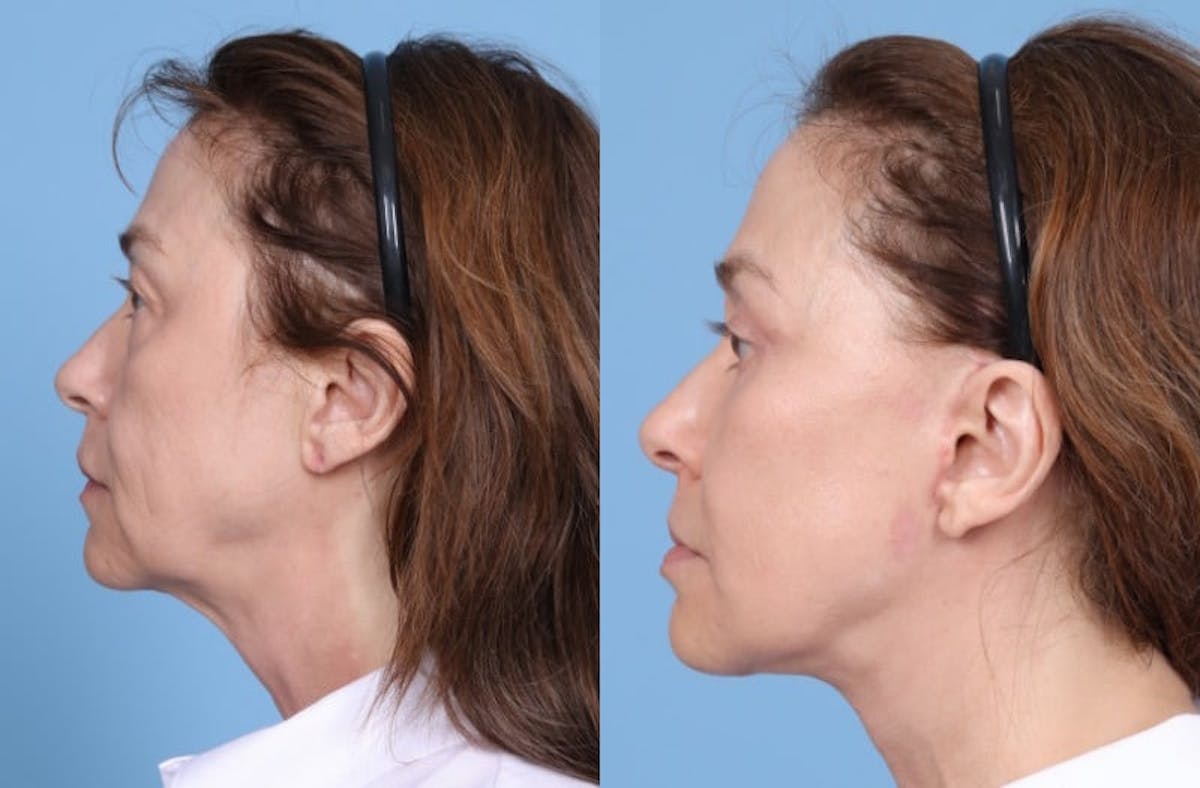 Facelift Before & After Gallery - Patient 369997 - Image 4