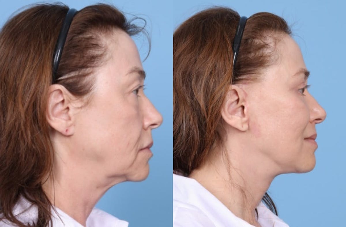 Facelift Before & After Gallery - Patient 369997 - Image 5