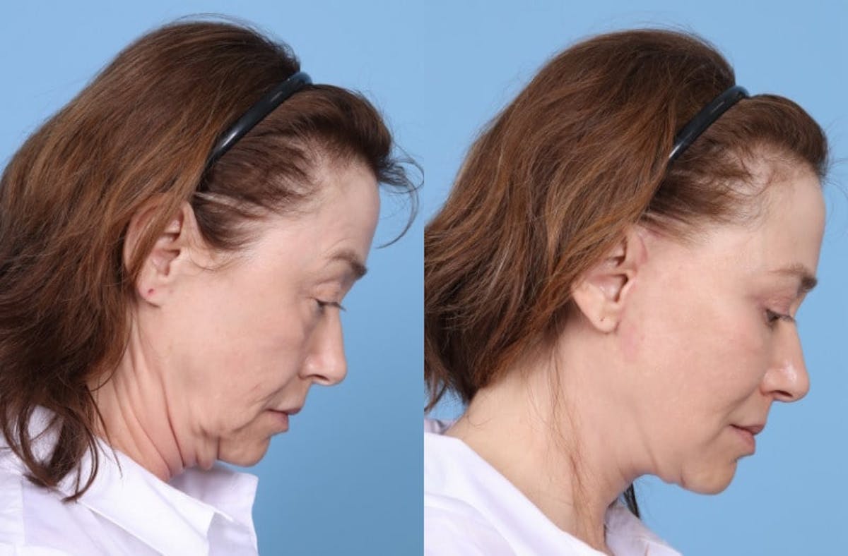 Facelift Before & After Gallery - Patient 369997 - Image 6