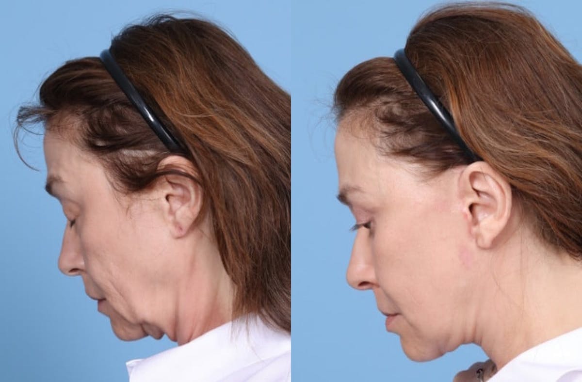 Facelift Before & After Gallery - Patient 369997 - Image 7