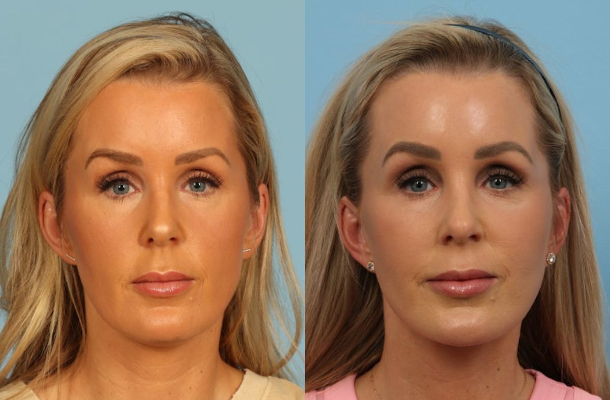 Facelift Before & After Gallery - Patient 325877 - Image 1