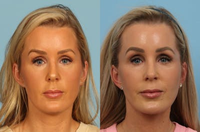 Facelift Before & After Gallery - Patient 325877 - Image 1