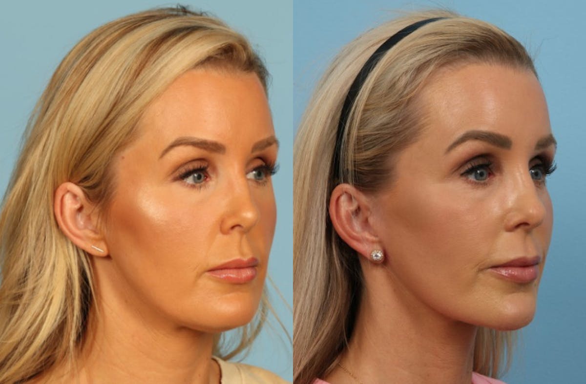 Facelift Before & After Gallery - Patient 325877 - Image 2