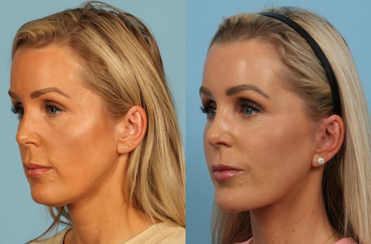 Facelift Before & After Gallery - Patient 325877 - Image 3