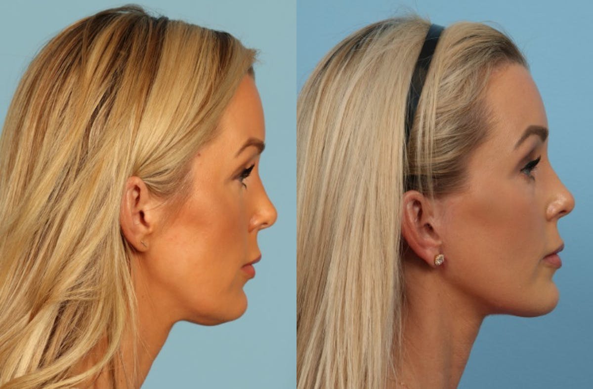 Facelift Before & After Gallery - Patient 325877 - Image 4