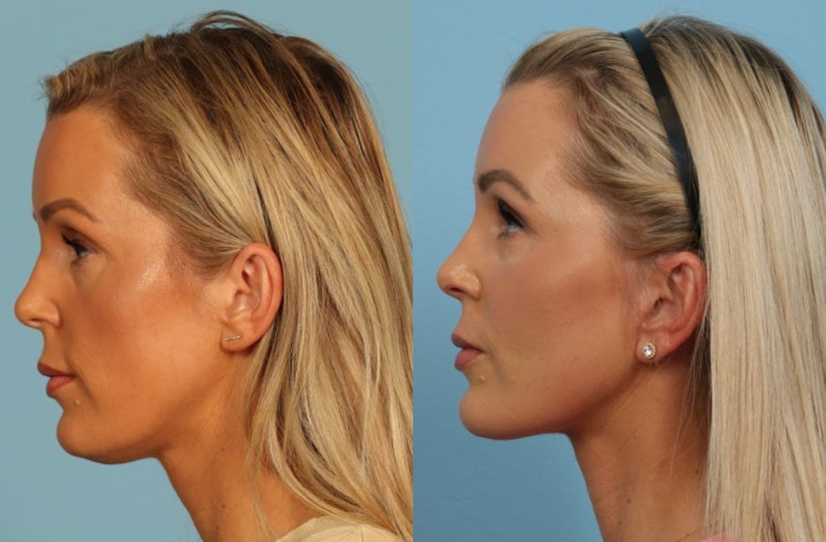 Facelift Before & After Gallery - Patient 325877 - Image 5