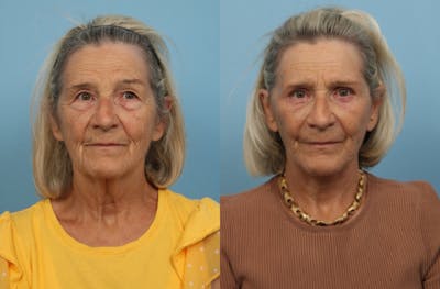 Facelift Before & After Gallery - Patient 311103 - Image 1
