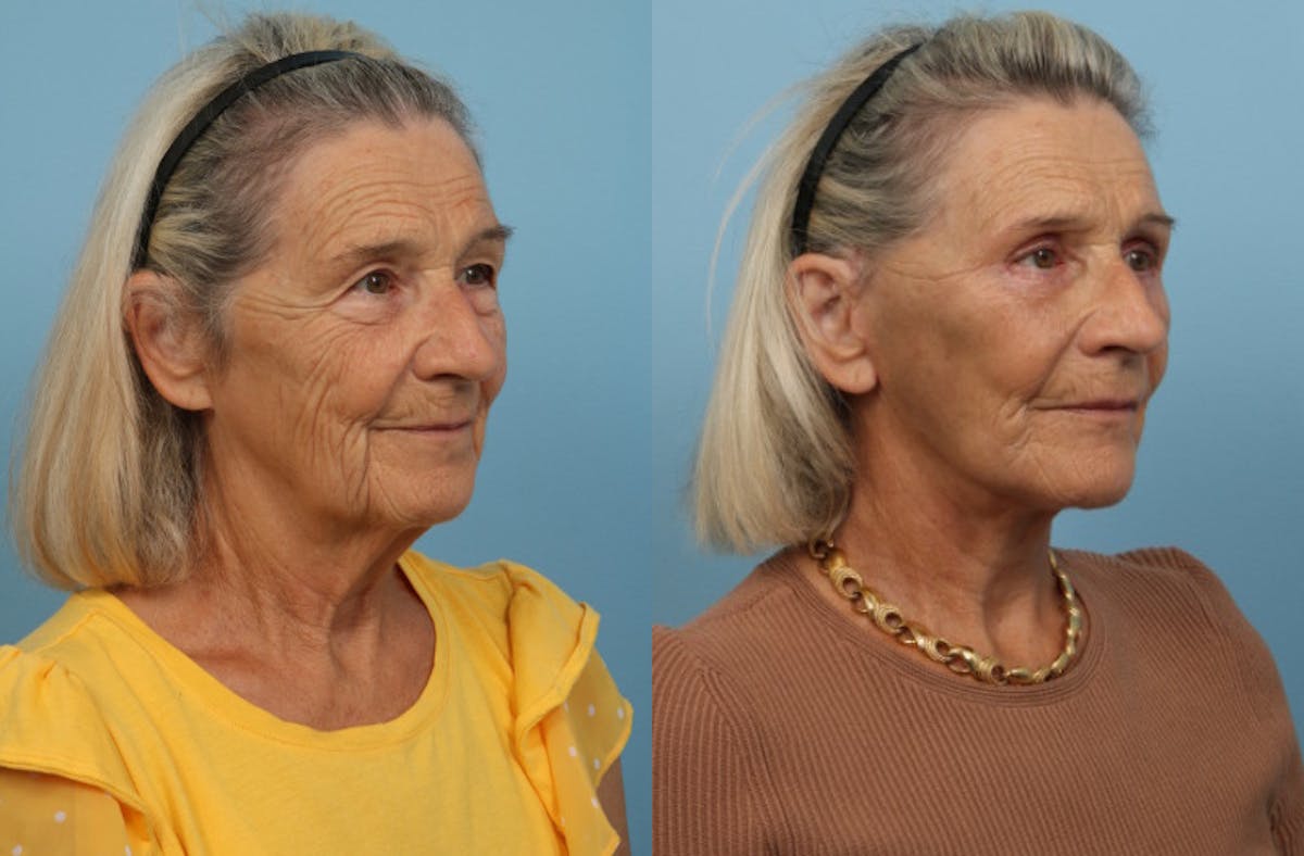 Facelift Before & After Gallery - Patient 311103 - Image 2