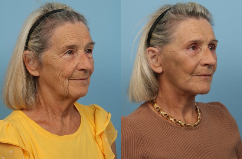 Facelift Before & After Gallery - Patient 311103 - Image 2
