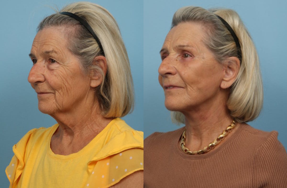 Facelift Before & After Gallery - Patient 311103 - Image 3