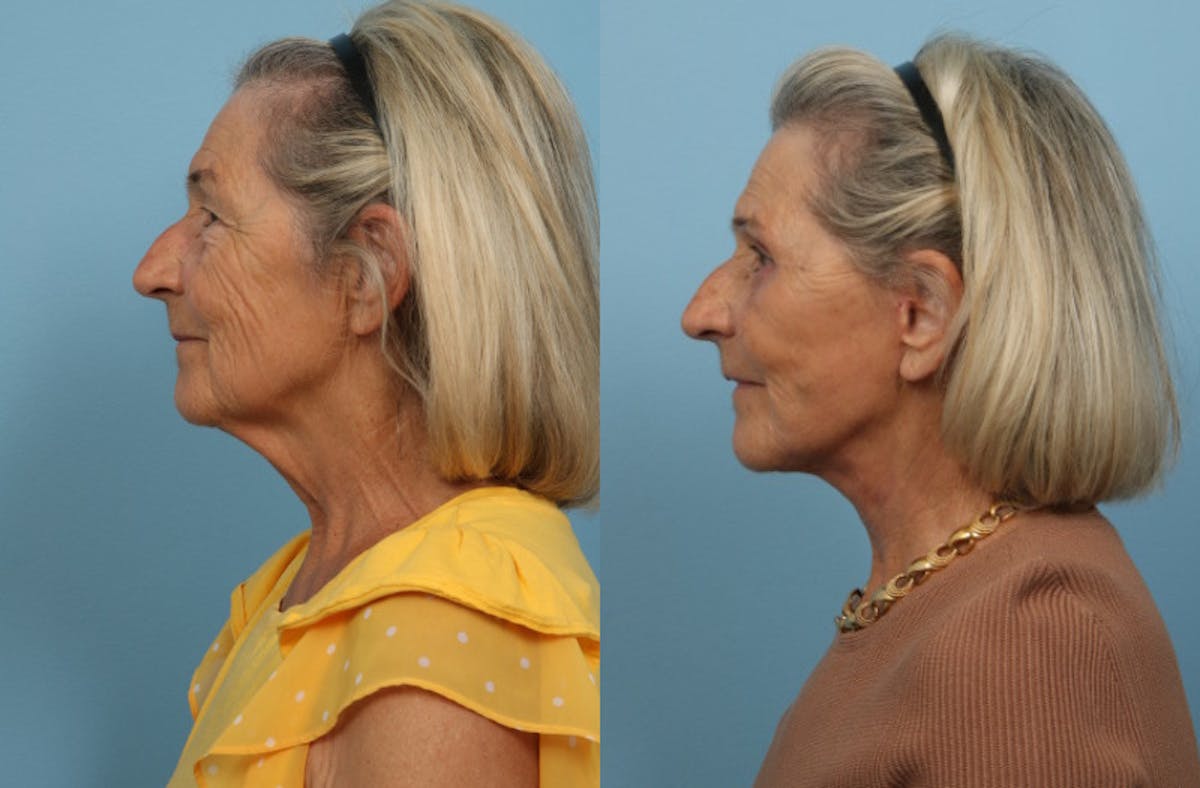 Facelift Before & After Gallery - Patient 311103 - Image 4
