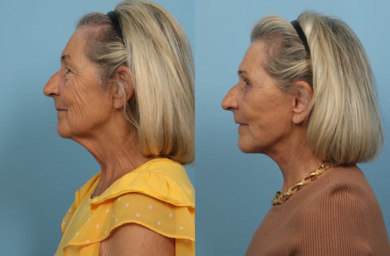 Facelift Before & After Gallery - Patient 311103 - Image 4