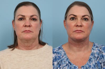 Facelift Before & After Gallery - Patient 296775 - Image 1