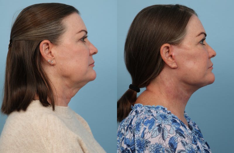 Facelift Before & After Gallery - Patient 296775 - Image 2