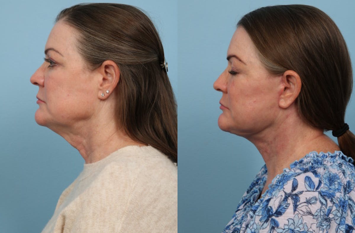 Facial Fat Grafting Before & After Gallery - Patient 122565 - Image 3