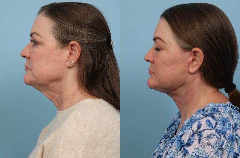 Facelift Before & After Gallery - Patient 296775 - Image 3