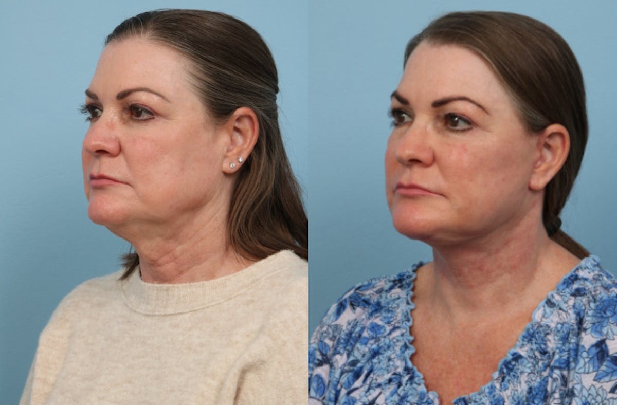 Facial Fat Grafting Before & After Gallery - Patient 122565 - Image 4