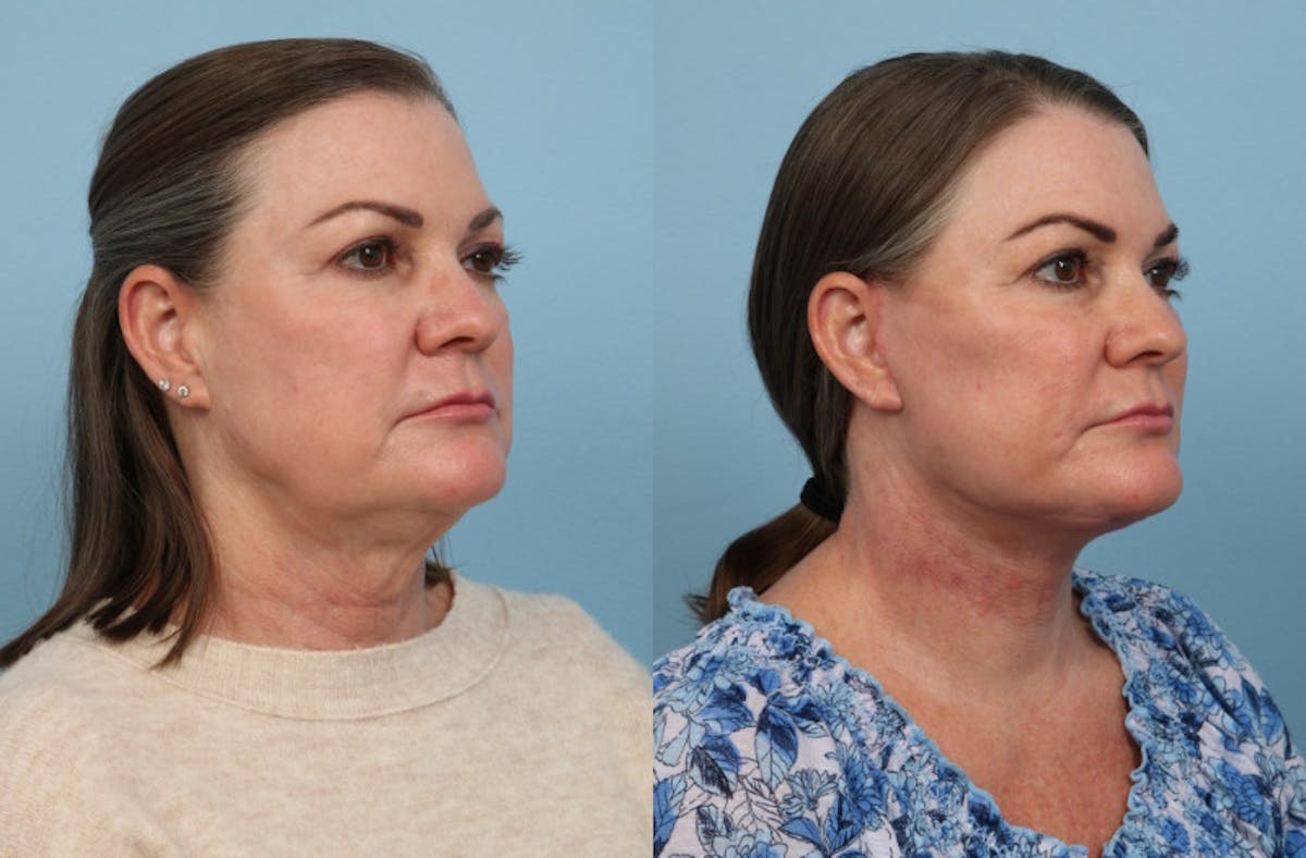 Facial Fat Grafting Before & After Gallery - Patient 122565 - Image 5