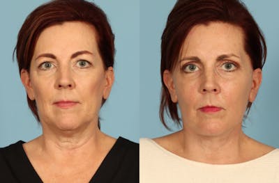 Facelift Before & After Gallery - Patient 126302 - Image 1