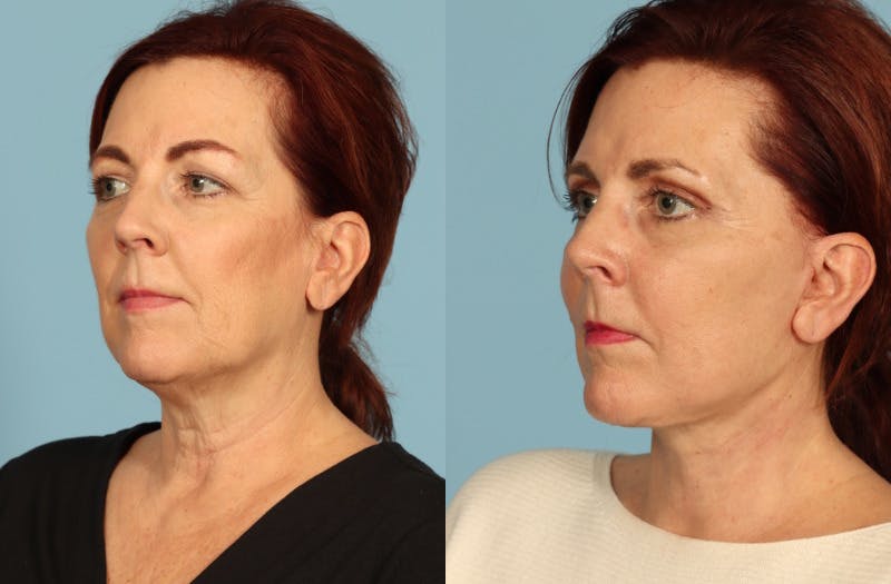 Facial Fat Grafting Before & After Gallery - Patient 148201 - Image 2