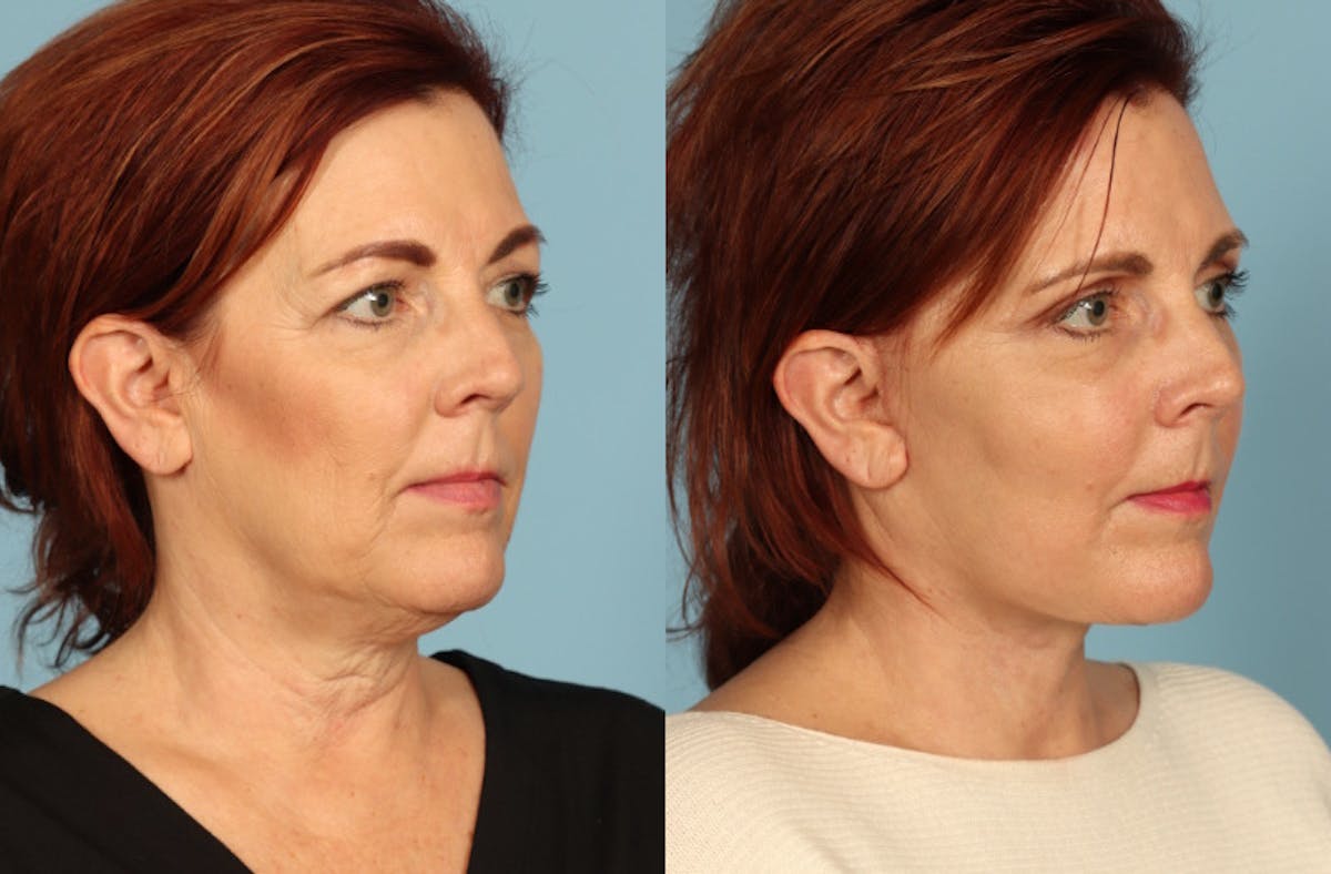 Facelift Before & After Gallery - Patient 126302 - Image 3