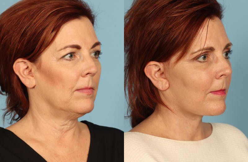 Facial Fat Grafting Before & After Gallery - Patient 148201 - Image 3