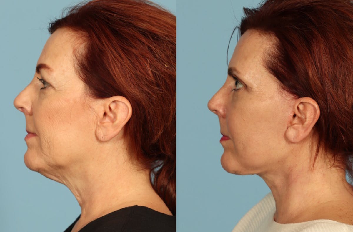 Facelift Before & After Gallery - Patient 126302 - Image 4