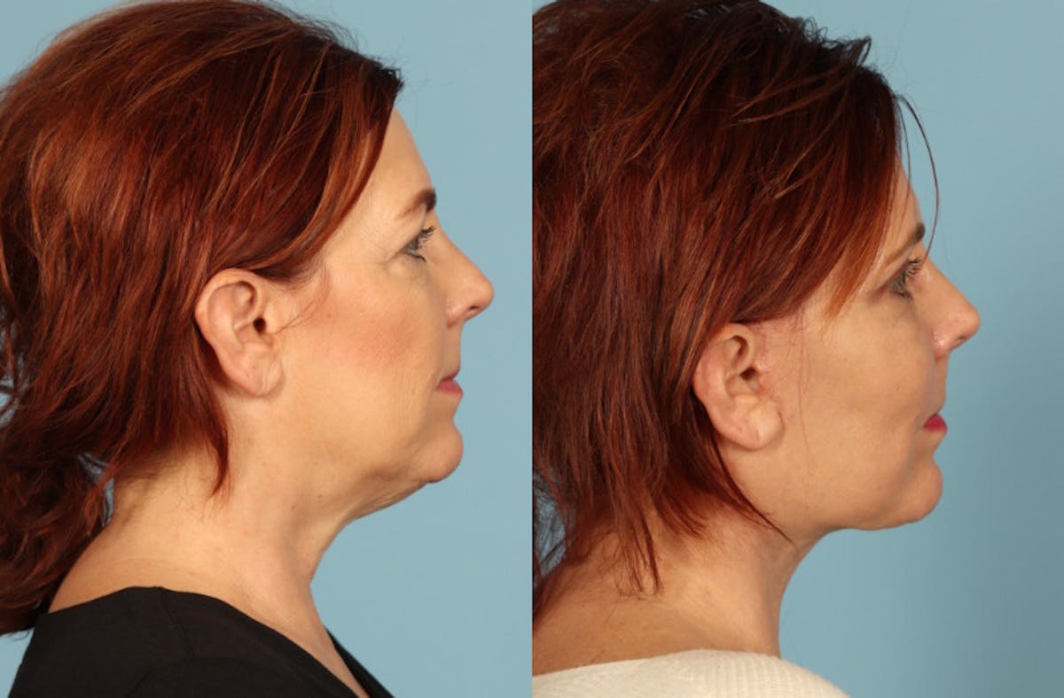 Facelift Before & After Gallery - Patient 126302 - Image 5