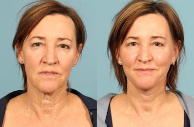 Facelift Before & After Gallery - Patient 124691 - Image 1