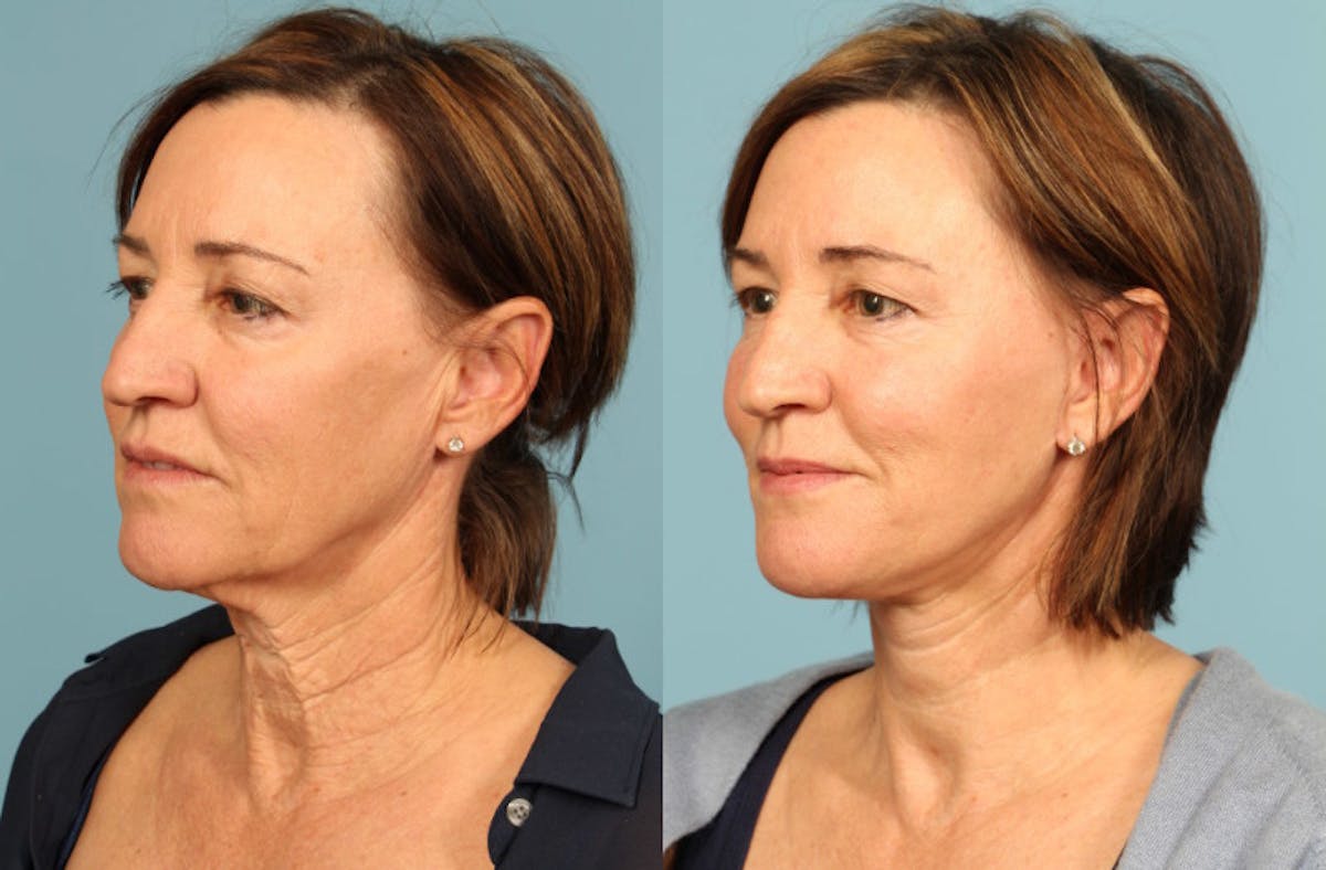 Facelift Before & After Gallery - Patient 124691 - Image 2