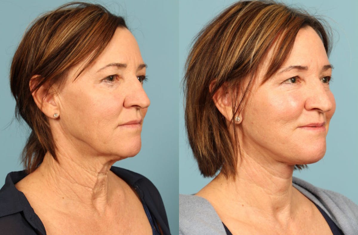 Facelift Before & After Gallery - Patient 124691 - Image 3