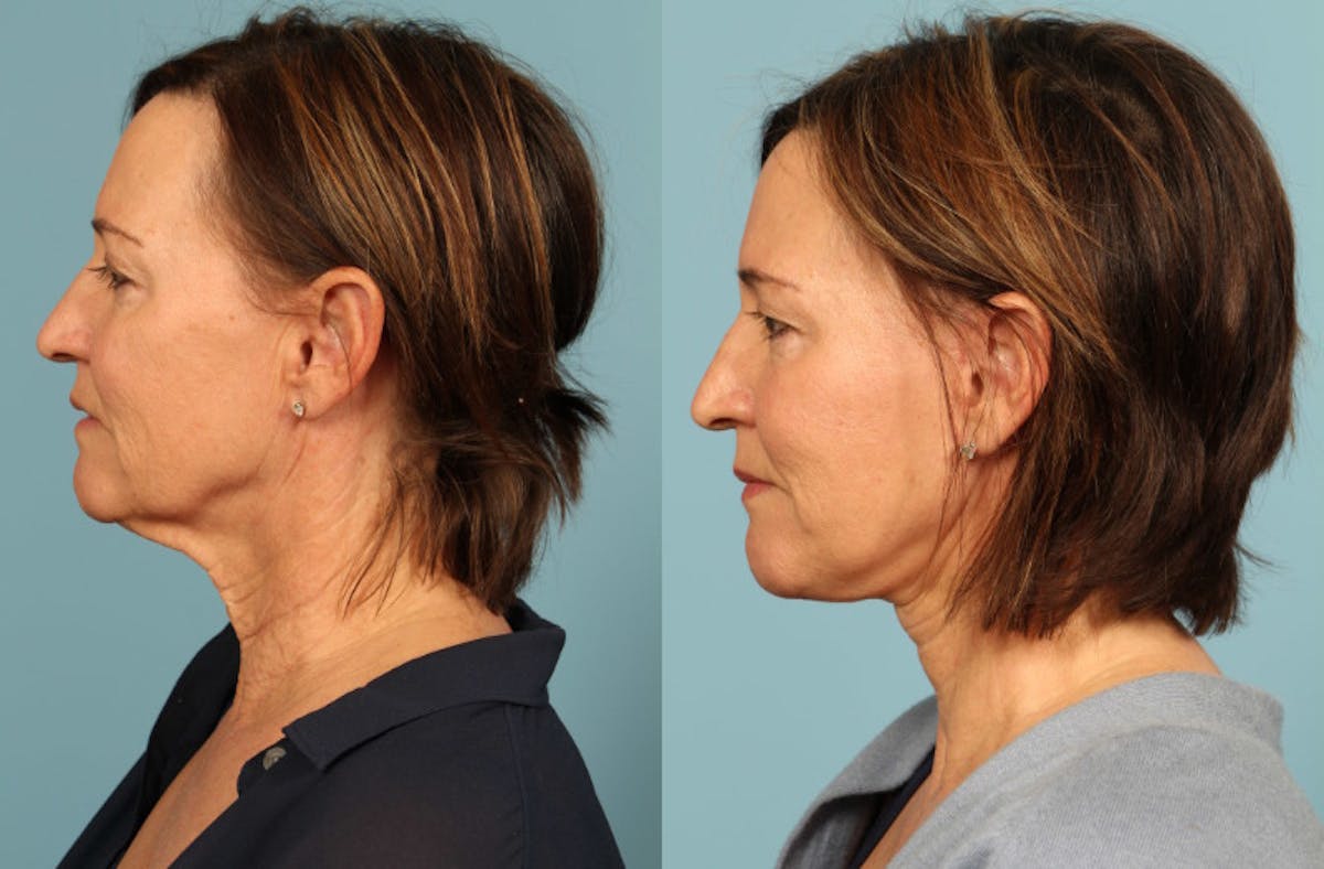 Facelift Before & After Gallery - Patient 124691 - Image 4