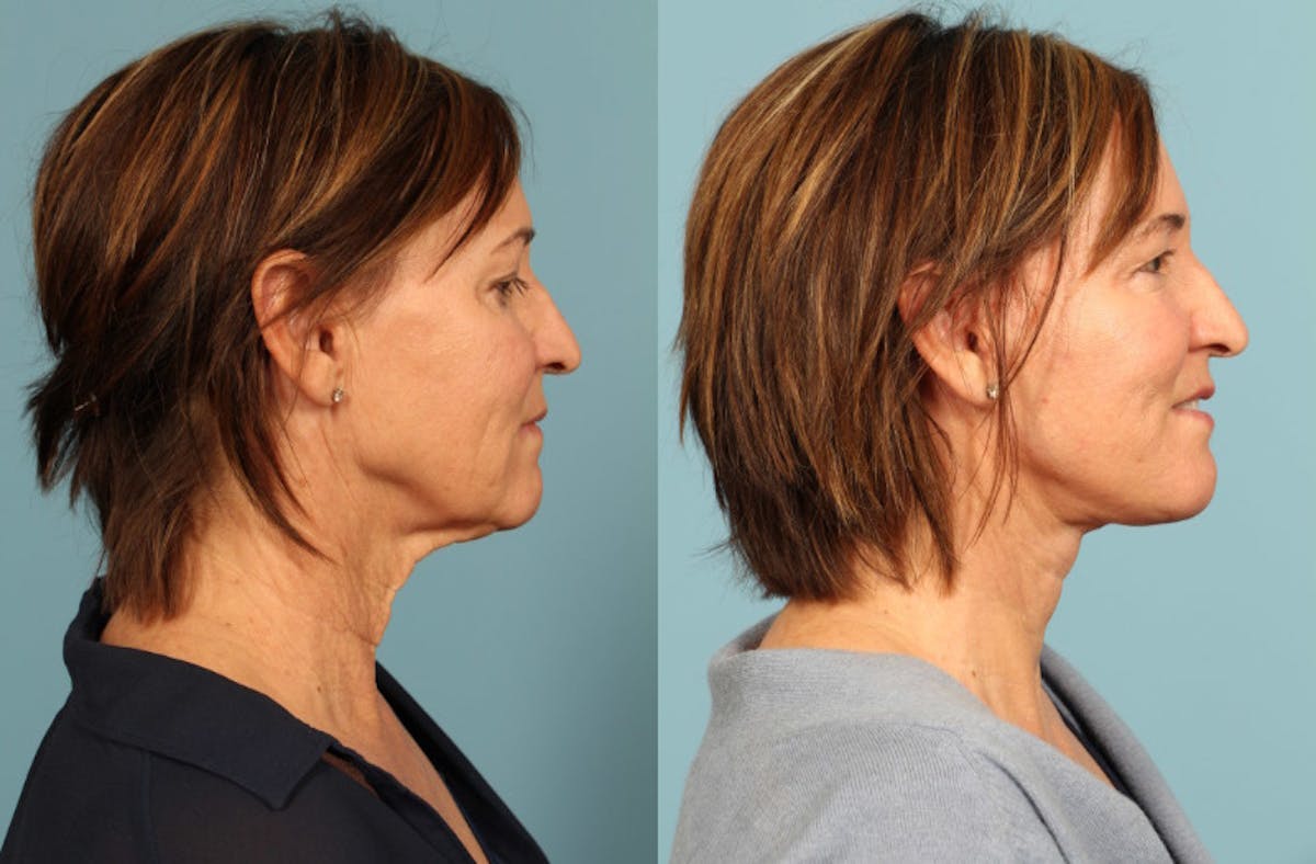 Facelift Before & After Gallery - Patient 124691 - Image 5