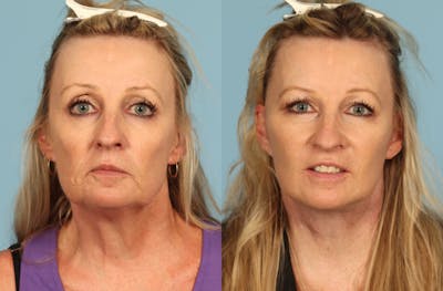 Facelift Before & After Gallery - Patient 145569 - Image 1