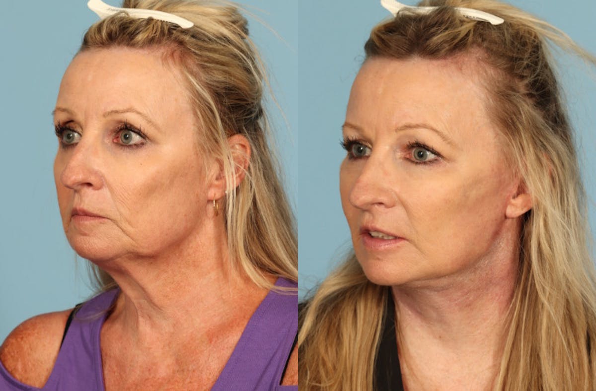 Facelift Before & After Gallery - Patient 145569 - Image 2