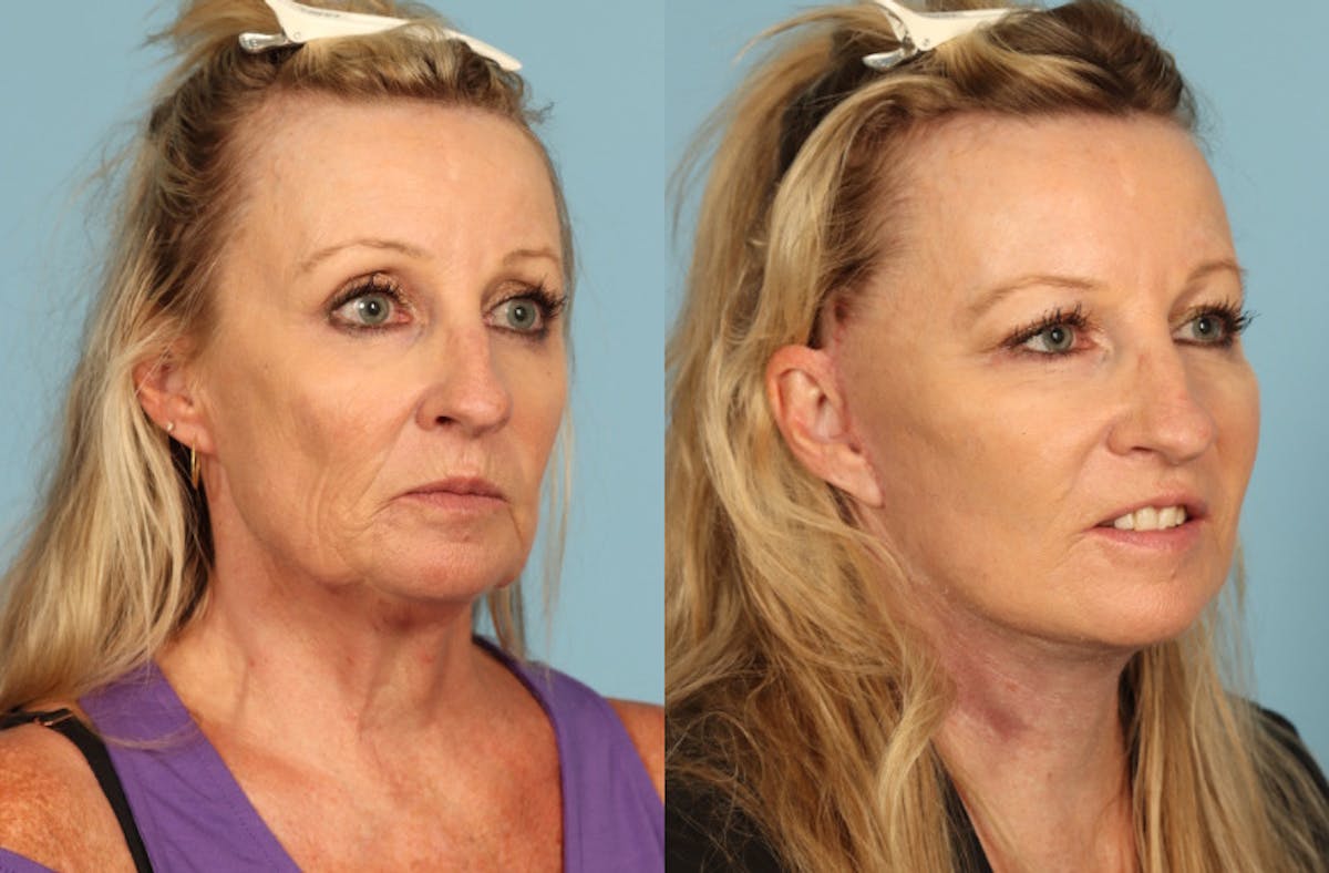 Facelift Before & After Gallery - Patient 145569 - Image 3