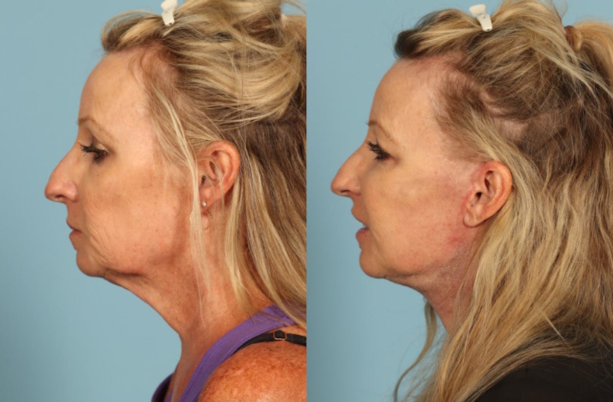 Facelift Before & After Gallery - Patient 145569 - Image 4