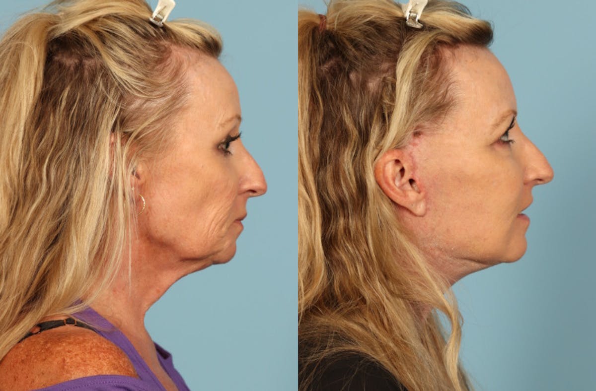 Facelift Before & After Gallery - Patient 145569 - Image 5