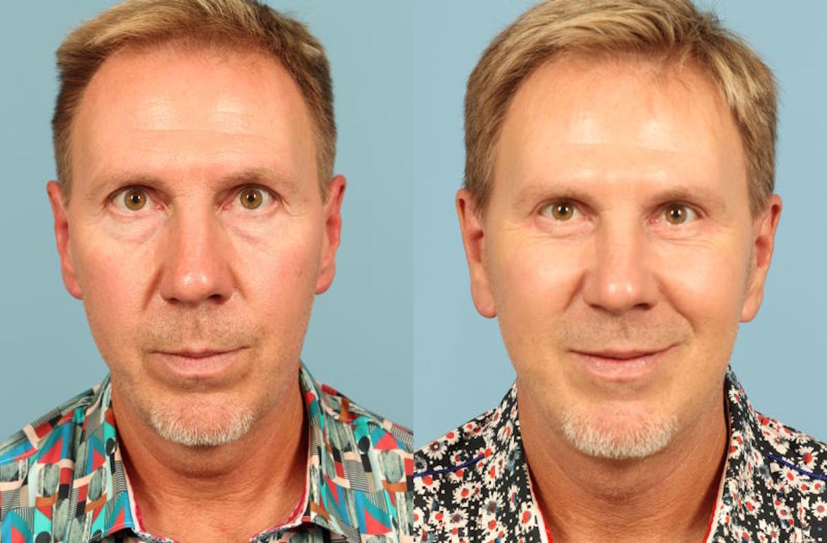 Facelift Before & After Gallery - Patient 394649 - Image 1