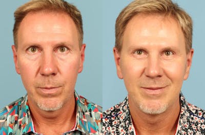 Facelift Before & After Gallery - Patient 394649 - Image 1
