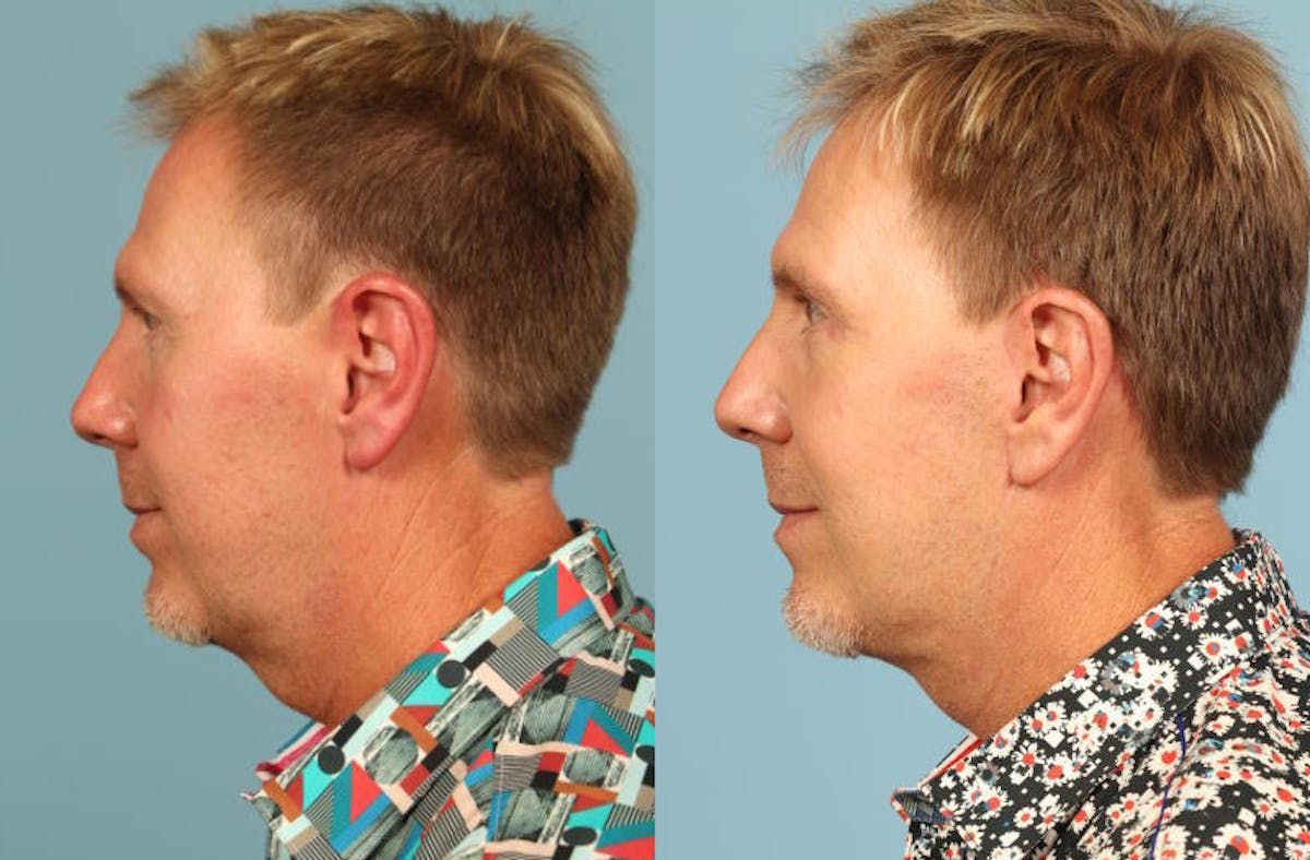 Facelift Before & After Gallery - Patient 394649 - Image 2